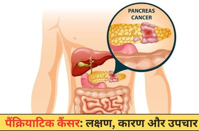 Pancreatic Cancer Pancreatic Cancer